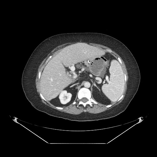Closed loop small bowel obstruction - internal hernia (Radiopaedia 65402-74450 A 33).jpg