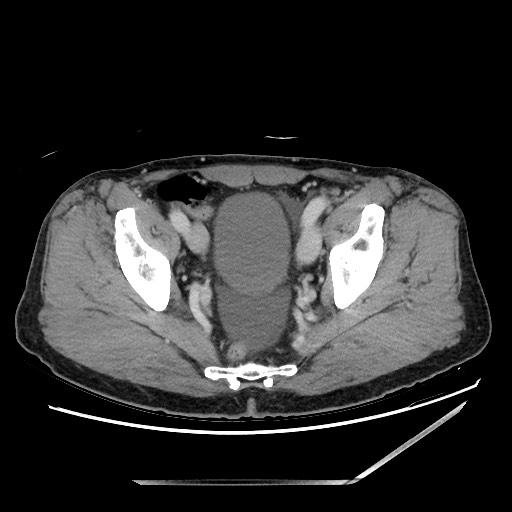Closed loop small bowel obstruction - omental adhesion causing "internal hernia" (Radiopaedia 85129-100682 A 146).jpg