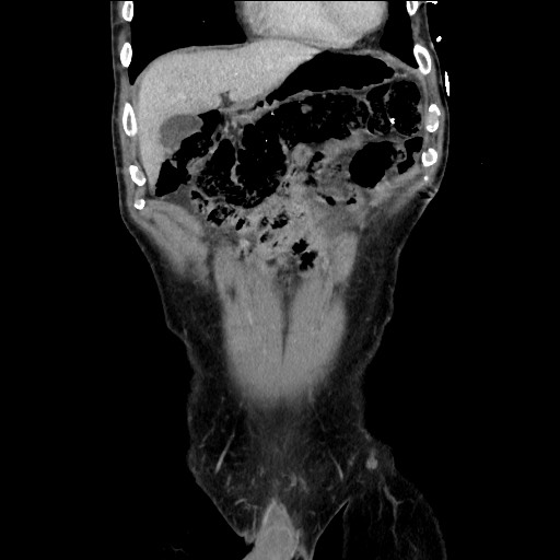Closed loop small bowel obstruction - omental adhesion causing "internal hernia" (Radiopaedia 85129-100682 B 35).jpg
