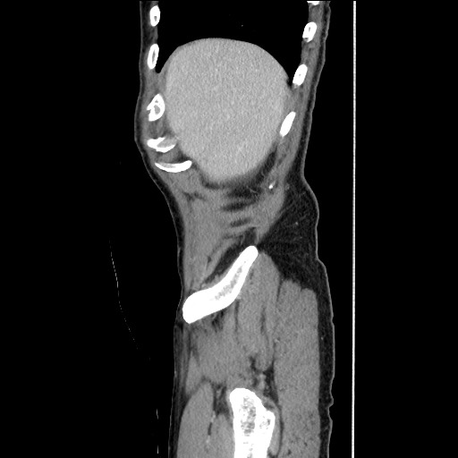 Closed loop small bowel obstruction - omental adhesion causing "internal hernia" (Radiopaedia 85129-100682 C 35).jpg