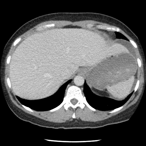 File:Closed loop small bowel obstruction due to trans-omental herniation (Radiopaedia 35593-37109 A 20).jpg