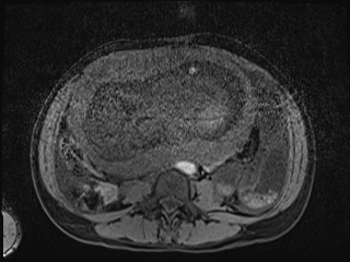 Closed loop small bowel obstruction in pregnancy (MRI) (Radiopaedia 87637-104031 F 10).jpg
