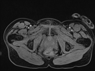 Closed loop small bowel obstruction in pregnancy (MRI) (Radiopaedia 87637-104031 G 28).jpg