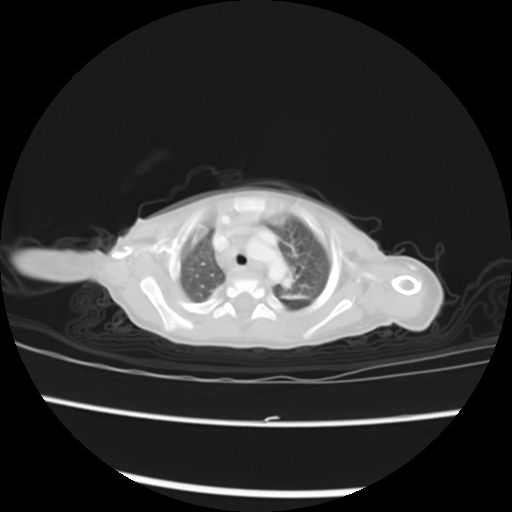 Coarctation of the aorta and patent ductus arteriosus (Radiopaedia 68033-77499 Axial lung window 6).jpg
