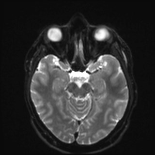 File:Cochlear incomplete partition type III associated with hypothalamic hamartoma (Radiopaedia 88756-105498 Axial DWI 16).jpg
