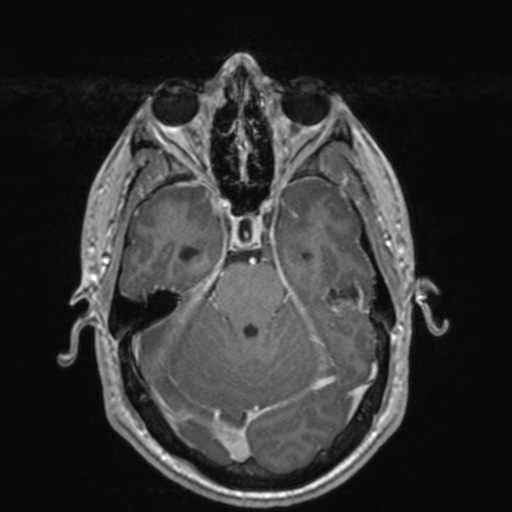File:Colloid cyst (Radiopaedia 44510-48181 Axial T1 C+ 65).png