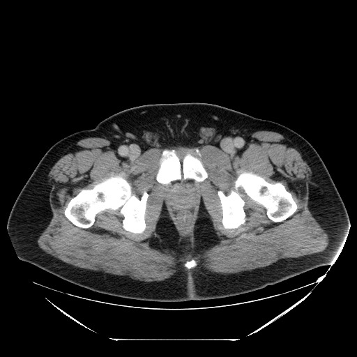 Colocolic intussusception due to lipoma (Radiopaedia 73712-84508 A 117).jpg