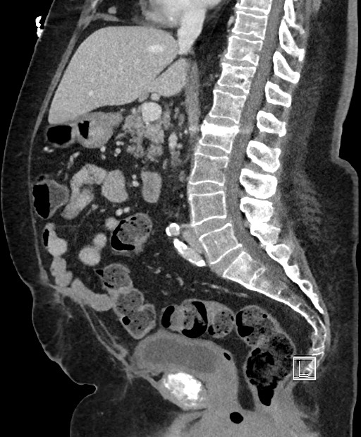 Colon adenocarcinoma (Radiopaedia 59374-66735 C 37).jpg