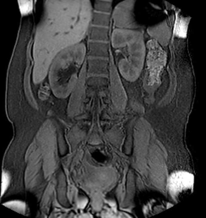 Colon adenocarcinoma with Krukenberg tumors, advanced pregnancy (Radiopaedia 67279-76645 E 64).jpg