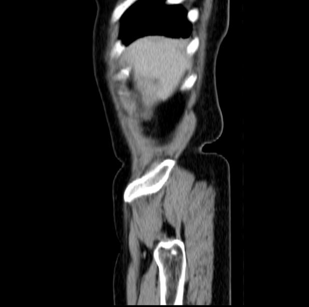 Colon carcinoma with hepatic metastases (Radiopaedia 29477-29961 C 5).jpg