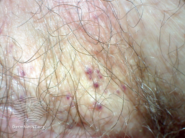 File:Dermoscopy of angiokeratoma of Fordyce on vulva (DermNet NZ angiokeratoma-49).jpg
