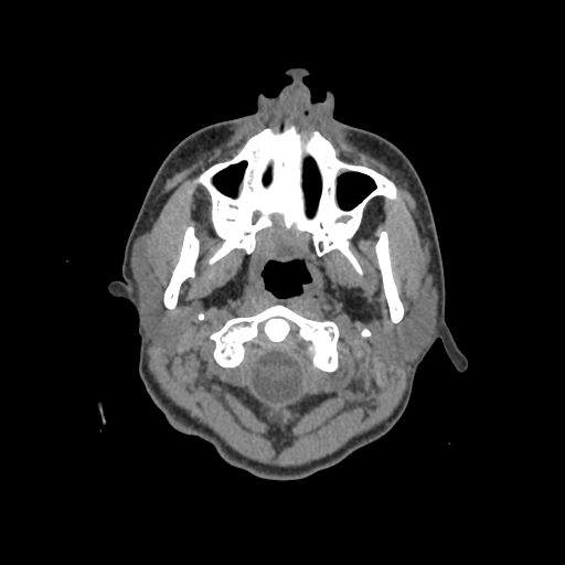 Nasal pyogenic granuloma (lobular capillary hemangioma) (Radiopaedia 85536-101244 Axial non-contrast 6).jpg
