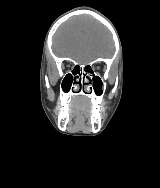Nasal pyogenic granuloma (lobular capillary hemangioma) (Radiopaedia 85536-101244 Coronal non-contrast 92).jpg