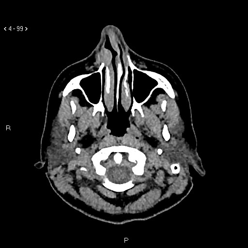 Nasolabial cyst (Radiopaedia 75125-86194 Axial non-contrast 61).jpg