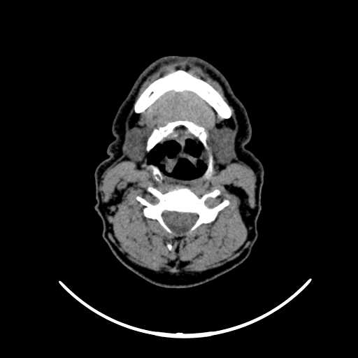 File:Nasopharyngeal carcinoma - infiltrating the clivus (Radiopaedia 62583-70875 Axial non-contrast 43).jpg