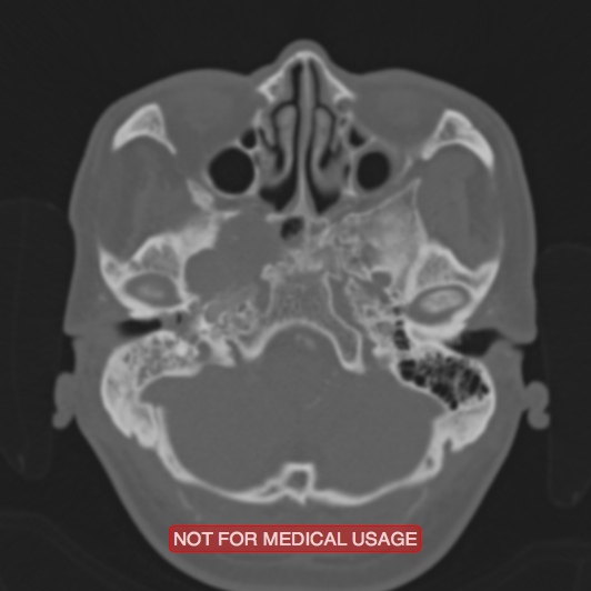Nasopharyngeal carcinoma recurrence - skull base destruction (Radiopaedia 29107-29490 Axial bone window 87).jpg