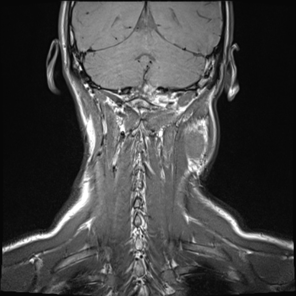 Nasopharyngeal carcinoma with skull base invasion (Radiopaedia 53415-59485 Coronal T1 4).jpg