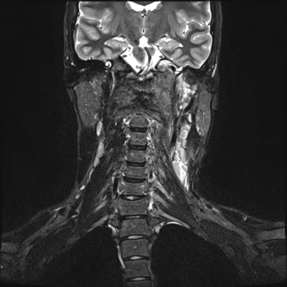 Nasopharyngeal carcinoma with skull base invasion (Radiopaedia 53415-59485 Coronal T2 fat sat 14).jpg