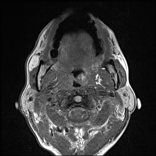 Nasopharyngeal carcinoma with skull base invasion (Radiopaedia 59258-66600 B 31).jpg