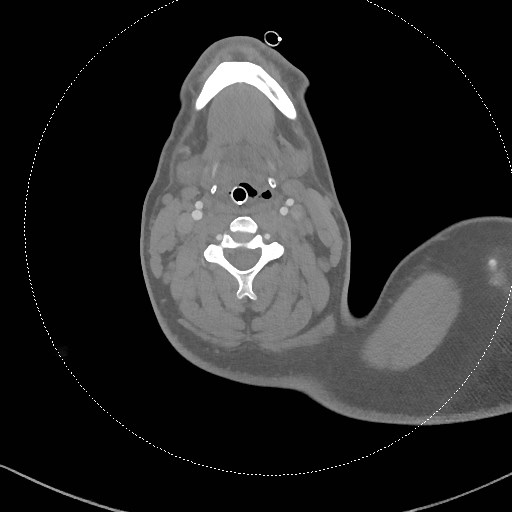 Neck CT angiogram (intraosseous vascular access) (Radiopaedia 55481-61945 B 185).jpg