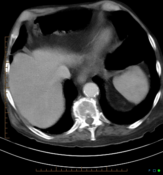 Necrotzing fasciitis due to a perforated adenocarcinoma of the splenic flexure (Radiopaedia 46930-51455 A 16).jpg