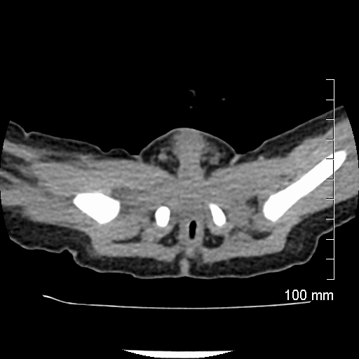 File:Neonatal neuroblastoma (Radiopaedia 56651-63438 Axial non-contrast 84).jpg