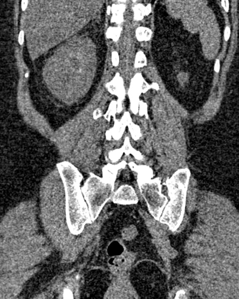 File:Nephrostomy for urosepsis (Radiopaedia 26180-26330 non-contrast 67).jpg