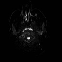 File:Neuro-Behcet's disease (Radiopaedia 21557-21506 Axial DWI 1).jpg