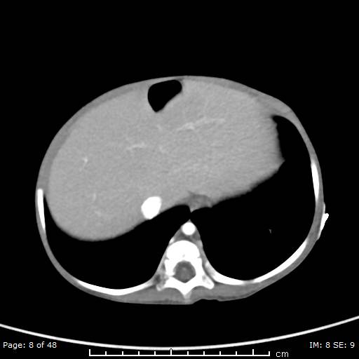 File:Neuroblastoma (Radiopaedia 41472-44355 A 8).jpg