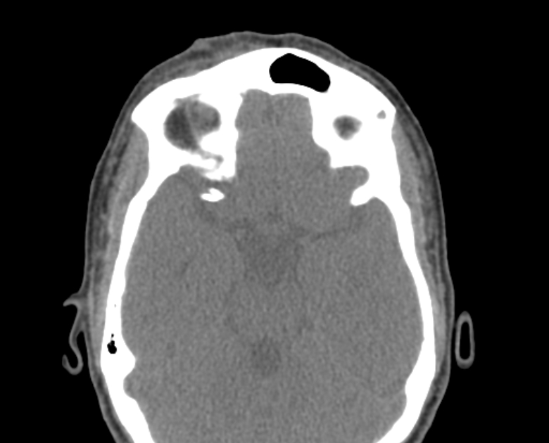 Neurofibromatosis type 1- orbital manifestations (Radiopaedia 49391-54511 Axial non-contrast 61).jpg