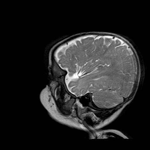 File:Neurofibromatosis type 1 (Radiopaedia 30089-30671 Sagittal T2 1).jpg