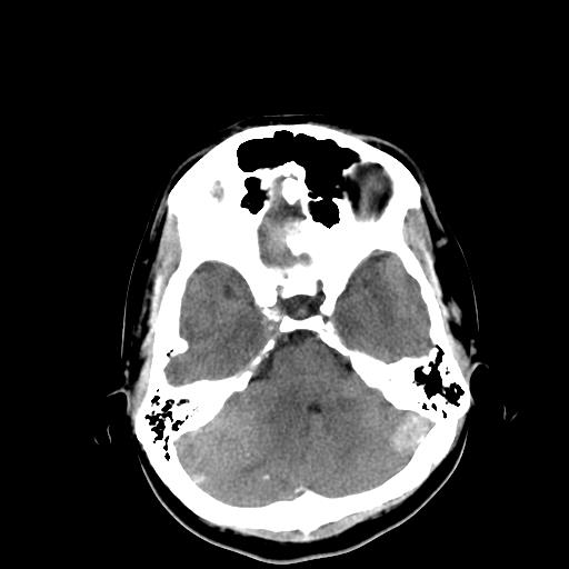 File:Neurofibromatosis type 2 (Radiopaedia 25389-25637 Axial non-contrast 7).jpg