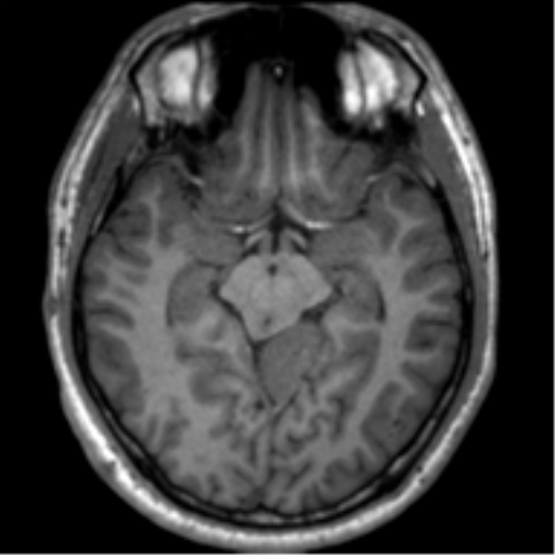 File:Neurofibromatosis type 2 (Radiopaedia 44936-48838 Axial T1 57).png