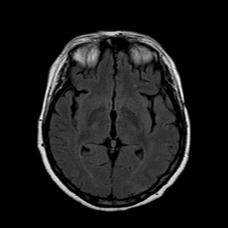 File:Neurofibromatosis type 2 (Radiopaedia 8713-9518 Axial FLAIR 13).jpg