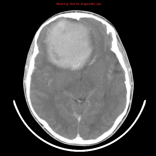 File:Neurofibromatosis type 2 (Radiopaedia 8953-9732 C 17).jpg