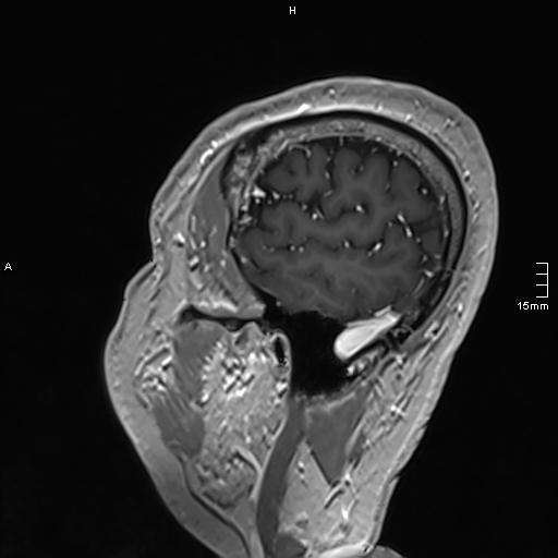 Neurosarcoidosis - involvement of the mesial temporal lobes (Radiopaedia 67429-76820 Sagittal T1 C+ 145).jpg