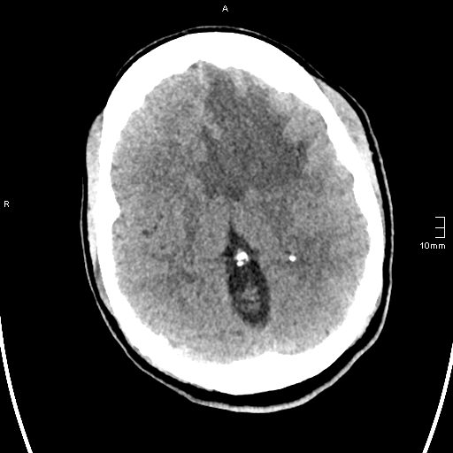File:Neurotoxoplasmosis - concentric target sign (Radiopaedia 70644-80783 Axial non-contrast 19).jpg