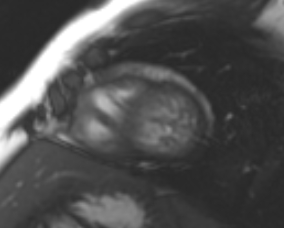 File:Non-compaction of the left ventricle (Radiopaedia 69436-79314 Short axis cine 69).jpg