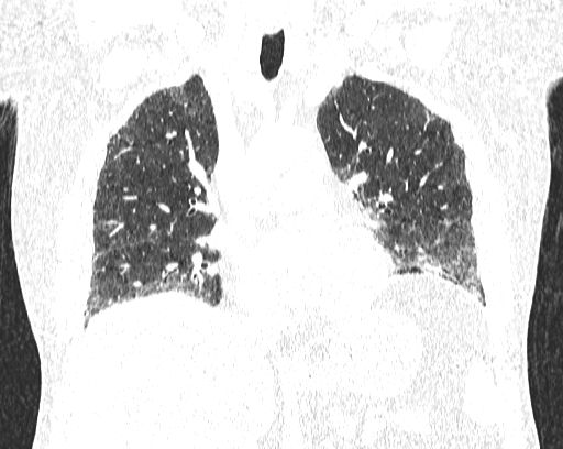 Non-specific interstitial pneumonia (NSIP) (Radiopaedia 68599-78228 Coronal lung window 42).jpg