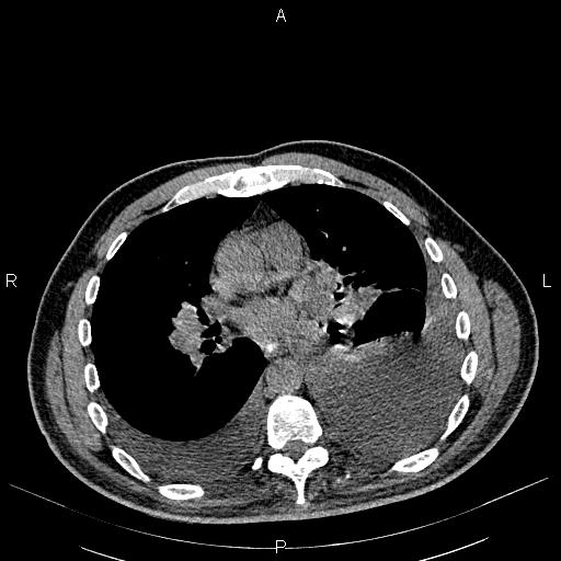 File:Non Hodgkin lymphoma in a patient with ankylosing spondylitis (Radiopaedia 84323-99621 Axial non-contrast 16).jpg