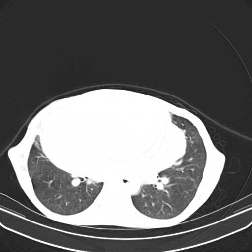 File:Non hodgkin lymphoma of the mediastinum (Radiopaedia 20814-20729 Axial lung window 31).jpg