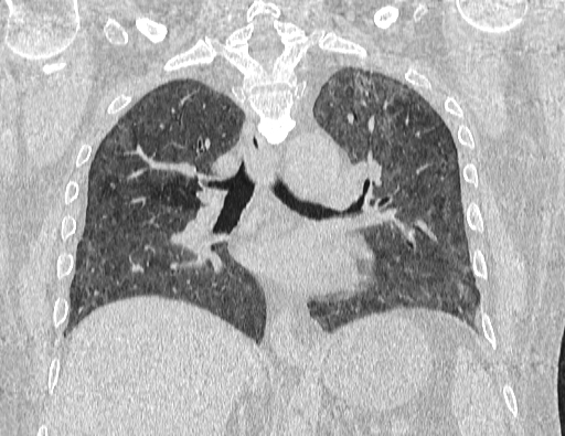 Non specific interstitial pneumonia (NSIP) (Radiopaedia 89725-106798 Coronal lung window 44).jpg