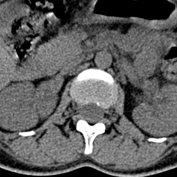 Normal CT lumbar spine (Radiopaedia 53981-60118 Axial non-contrast 24).jpg