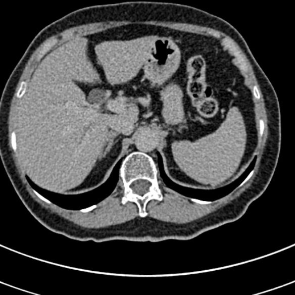 File:Normal CT split bolus study of the renal tract (Radiopaedia 48631-53634 Axial split bolus 11).jpg