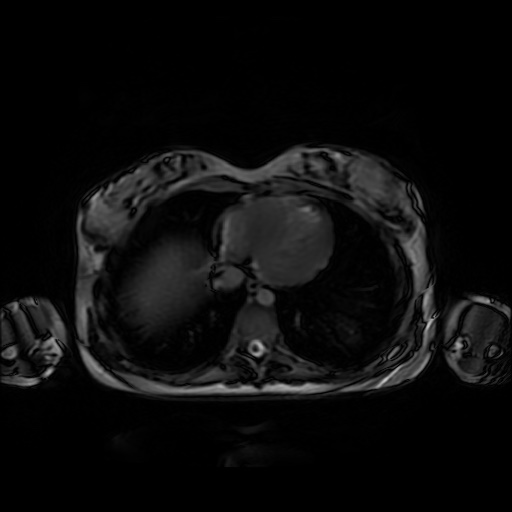 File:Normal MRI abdomen in pregnancy (Radiopaedia 88001-104541 Axial Gradient Echo 2).jpg