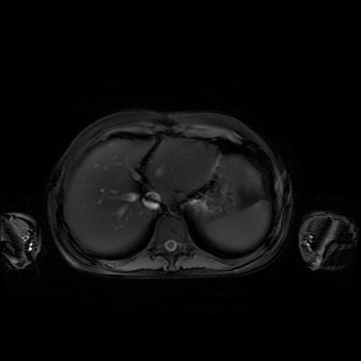 File:Normal MRI abdomen in pregnancy (Radiopaedia 88001-104541 D 8).jpg