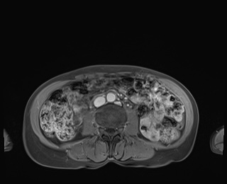 Normal adrenal glands MRI (Radiopaedia 82017-96004 M 59).jpg
