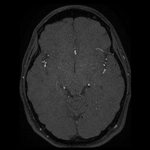 Normal brain MRA (Radiopaedia 41046-43793 Axial MRA 41).png