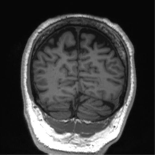 Normal brain MRI (non-focal epilepsy protocol) (Radiopaedia 53917-60040 Coronal T1 16).png