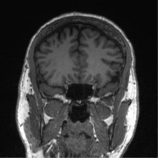Normal brain MRI (non-focal epilepsy protocol) (Radiopaedia 53917-60040 Coronal T1 48).png
